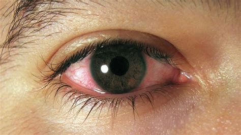 sintomas de ardor en los ojos